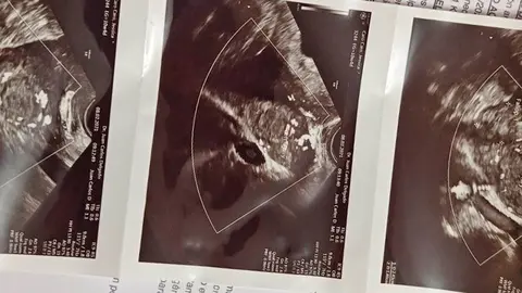 Ecograf&iacute;a de Erick, Hijo de Jessica Caro