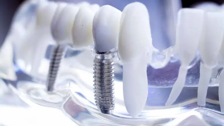 Implantes dentales