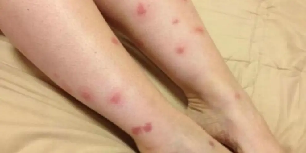 Picaduras de mosquito