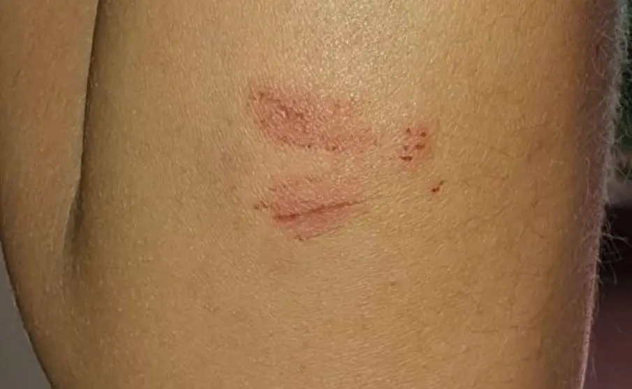 Herida de la v&iacute;ctima | @AbrirBrechaJRZ Twitter