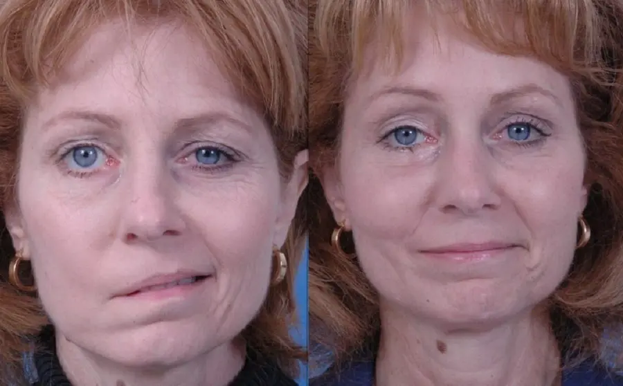 These before-and-after photos show the dramatic results achieved after temporalis tendon transfer surgery. The patient suffered from facial paralysis and underwent surgery in January 2008. (U.S. Air Force photo)