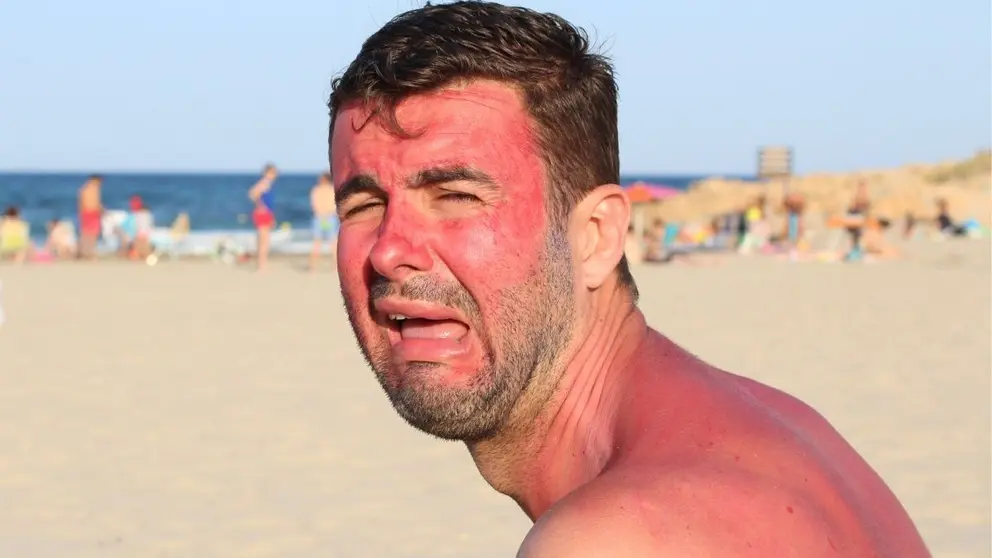 Hombre con la cara y el cuerpo quemados por tomar el sol sin protecci&oacute;n