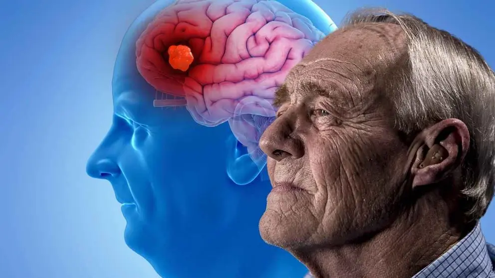 As&iacute; es como se produce la enfermedad de Alzheimer y se llega a la demencia