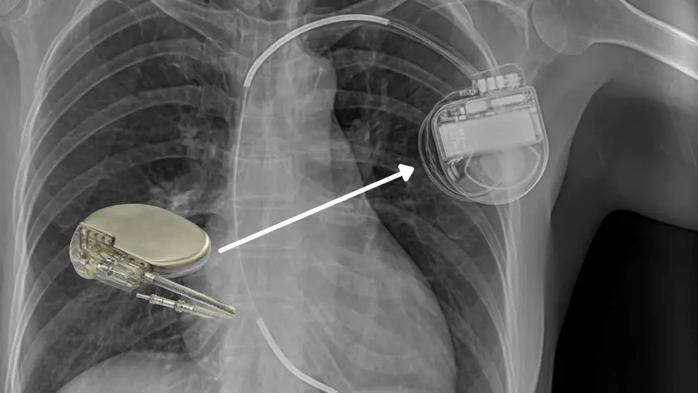 Este es el marcapasos que le han puesto al padre de Ana Obreg&oacute;n y que le ha salvado la vida