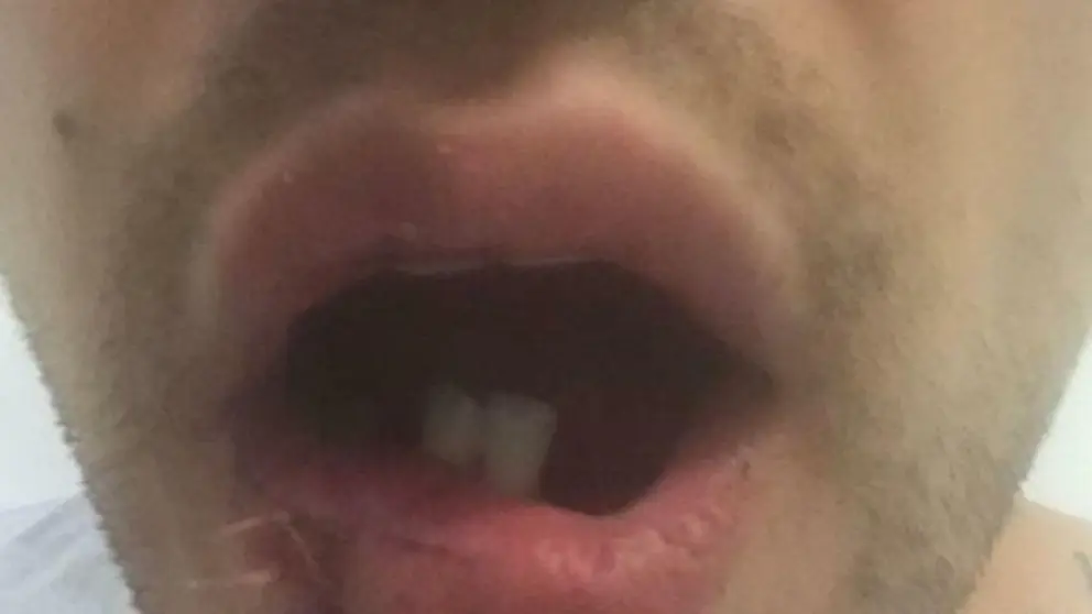 Hombre con la mand&iacute;bula destrozada en Almer&iacute;a