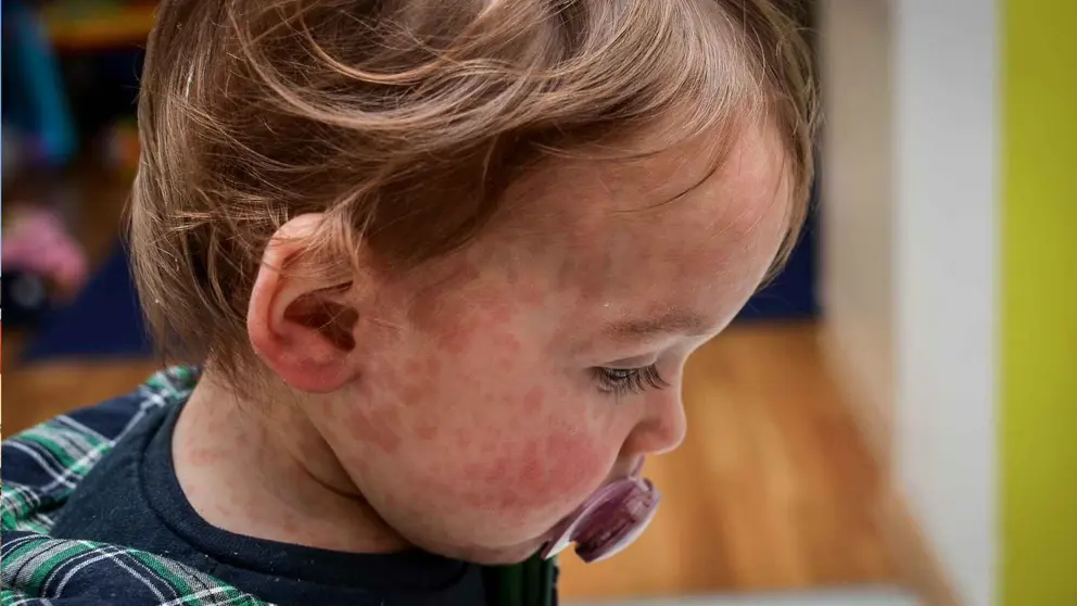 Brote de sarampi&oacute;n