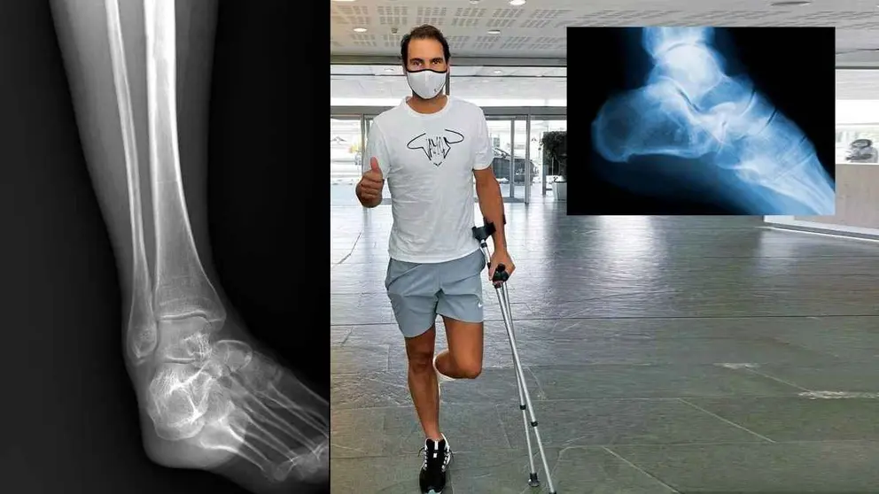 Rafael Nadal reaparece con muletas tras tratarse la displasia del escafoide tarsiano&nbsp;del pie izquierdo