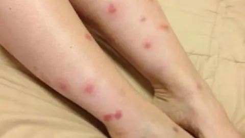 Picaduras de mosquito