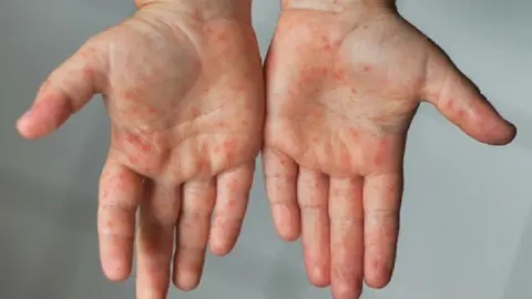 Alteraciones provocadas por el sndrome de Kawasaki, la enfermedad inflamatoria que afecta a los nios cuyo incremento ha sido puesto en relacin con el contagio de covid19.

(transm. V.Sokolowicz)