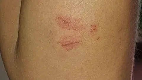 Herida de la v&iacute;ctima | @AbrirBrechaJRZ Twitter