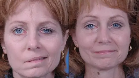 These before-and-after photos show the dramatic results achieved after temporalis tendon transfer surgery. The patient suffered from facial paralysis and underwent surgery in January 2008. (U.S. Air Force photo)