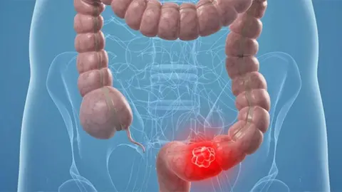 C&aacute;ncer de colon