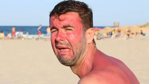 Hombre con la cara y el cuerpo quemados por tomar el sol sin protecci&oacute;n