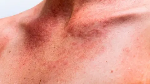 La alergia al sol puede ser muy peligrosa