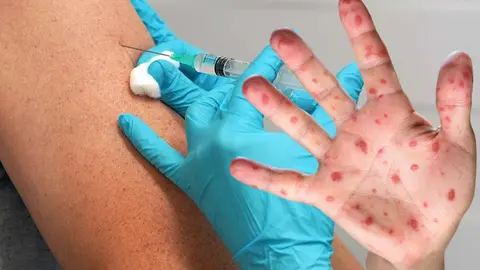 Importancia de la vacuna contra la Rubeola, Sarampi&oacute;n y la Parotiditis