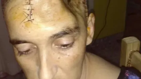 Una mujer entr&oacute; en coma por un dolor de muelas y acabaron extirp&aacute;ndole el cr&aacute;neo