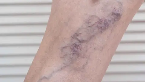 El 25% de personas con neumon&iacute;a por Covid-19 genera trombosis venosa profunda