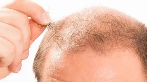 Alopecia 3 causas, 6 signos de alerta de la ca&iacute;da del cabello y c&oacute;mo tratarlo