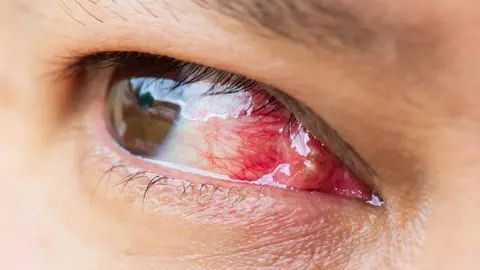 Alerta con el pterigion, una patolog&iacute;a frecuente en los ojos que si no se trata acaba en cirug&iacute;a