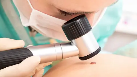 La Unidad de Dermatolog&iacute;a de C&aacute;diz crea una app para ayudar al diagn&oacute;stico de pacientes con melanoma maligno   