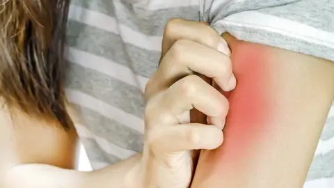 El motivo de que algunas alergias desaparecen solas con el paso de los a&ntilde;os