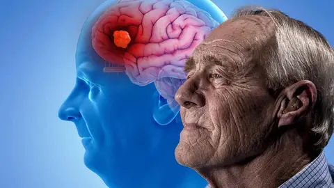 As&iacute; es como se produce la enfermedad de Alzheimer y se llega a la demencia