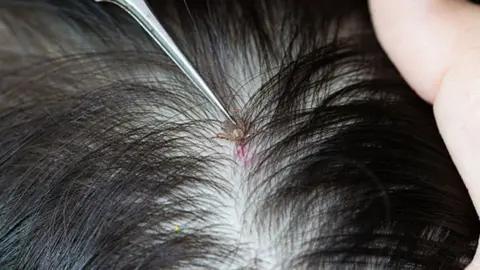 Alertan del regreso de los piojos, que afectaban al 40 de ni&ntilde;os de Andaluc&iacute;a