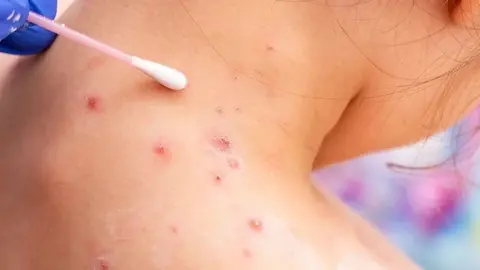 Muere una persona de 35 a&ntilde;os en Sevilla por un posible caso de viruela del mono