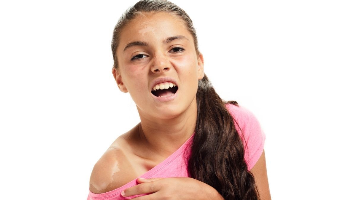 Niña con quemadura por insolación