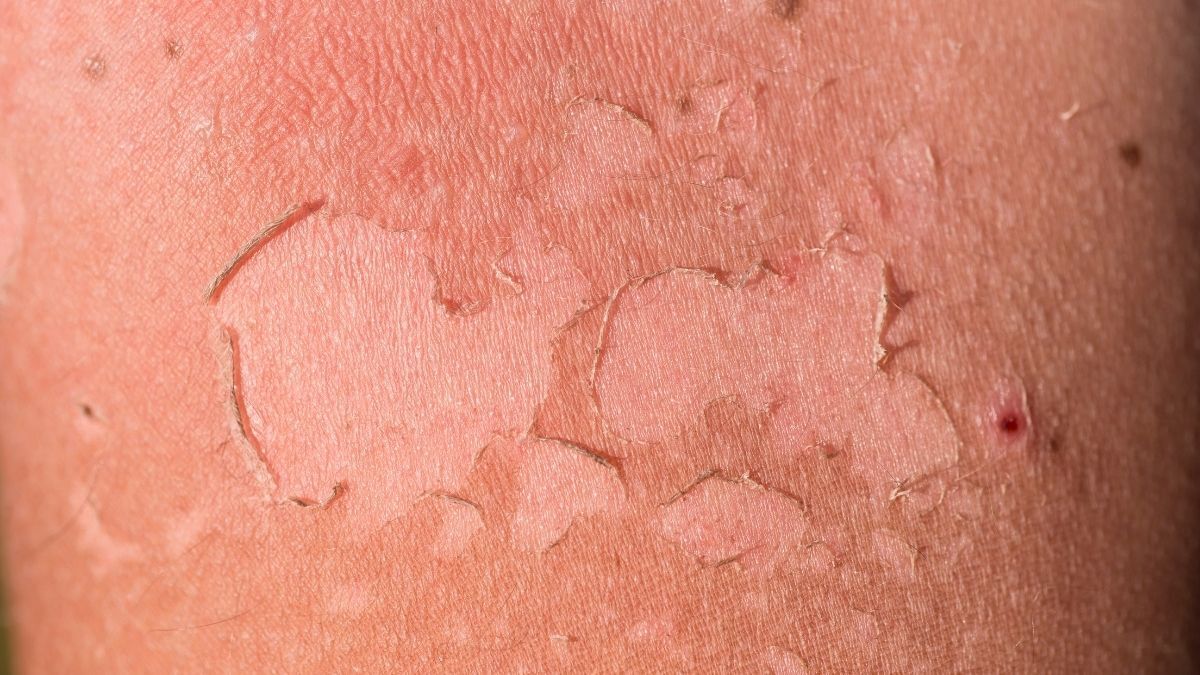 Quemaduras por insolación