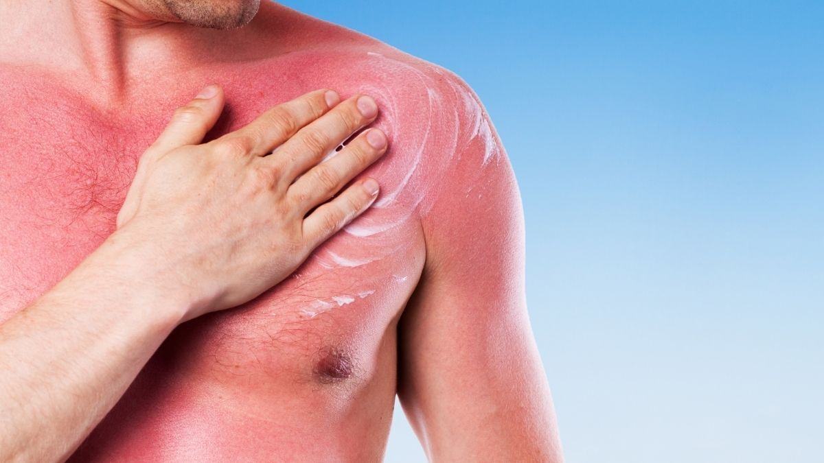 Hombre se coloca crema tras insolación