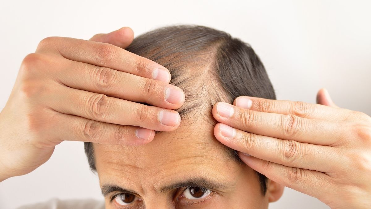 Pérdida de pelo en el hombre