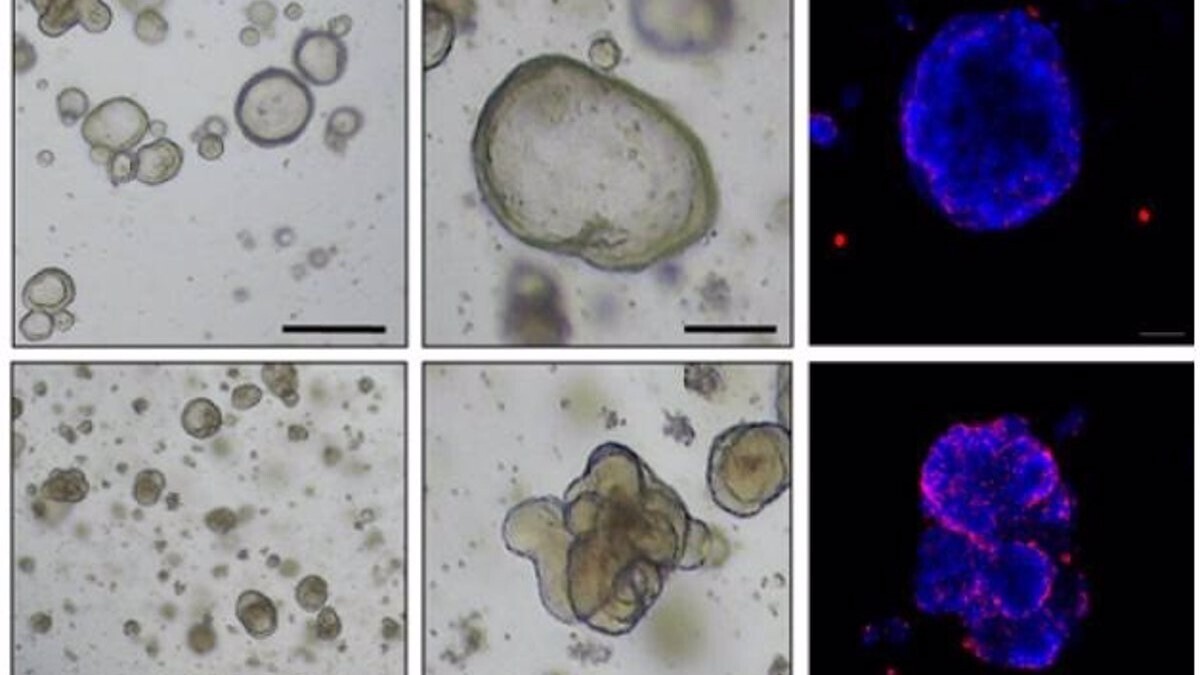 células cancerígenas