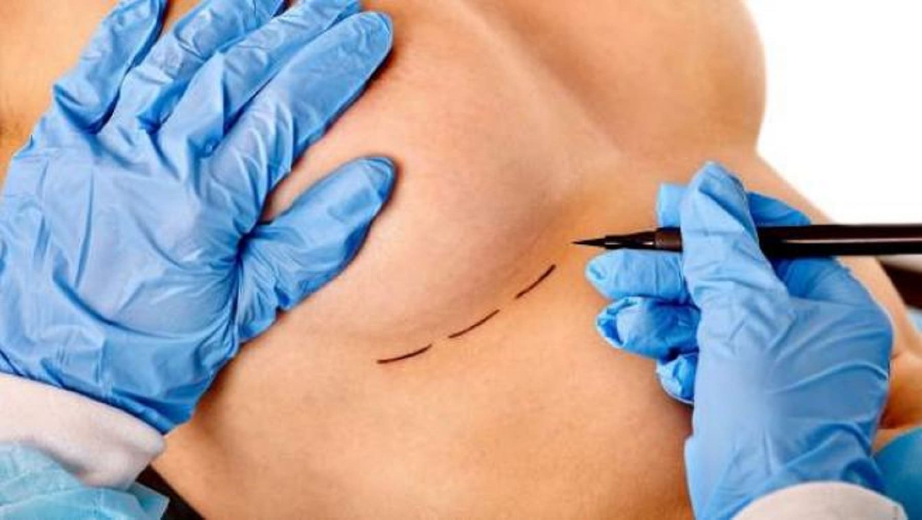 Una joven muere tras una operación de implantes mamarios