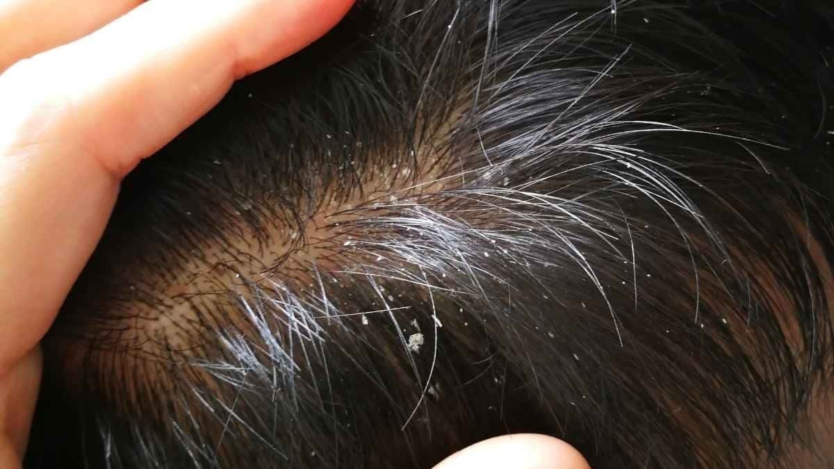 Cabello con caspa