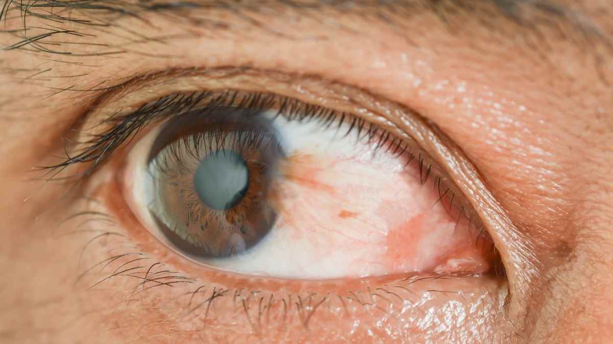 Alerta con el pterigion, una patología frecuente en los ojos que si no se trata acaba en cirugía 