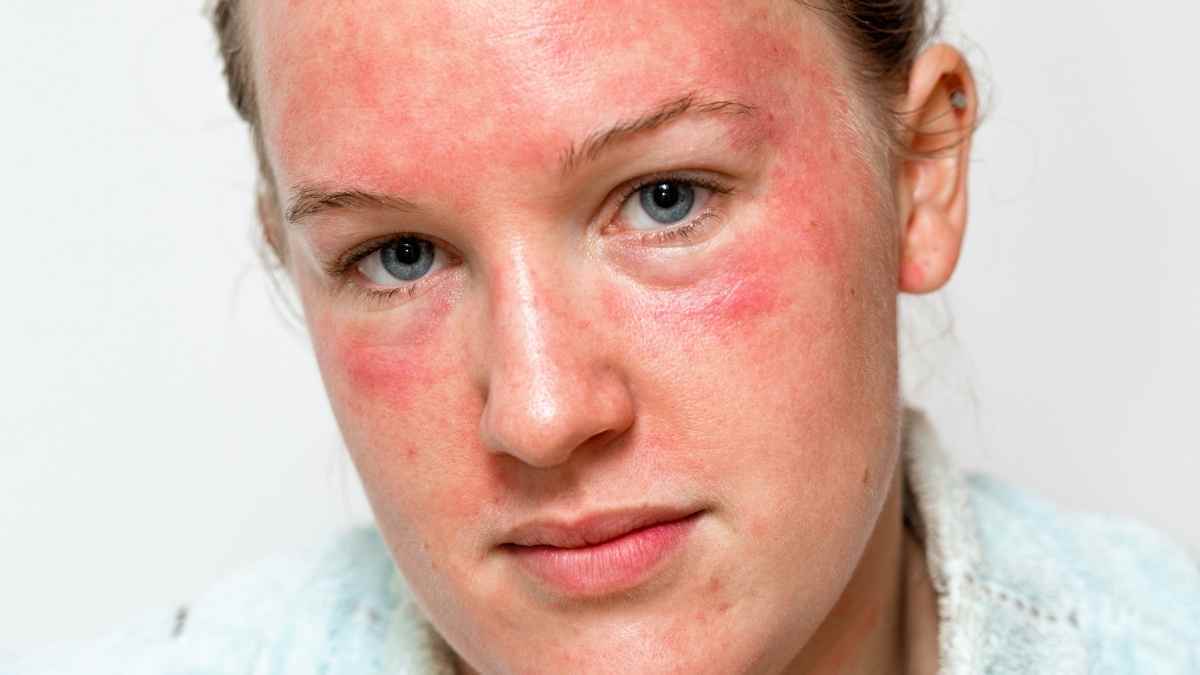 El motivo de que algunas alergias desaparecen solas con el paso de los años 