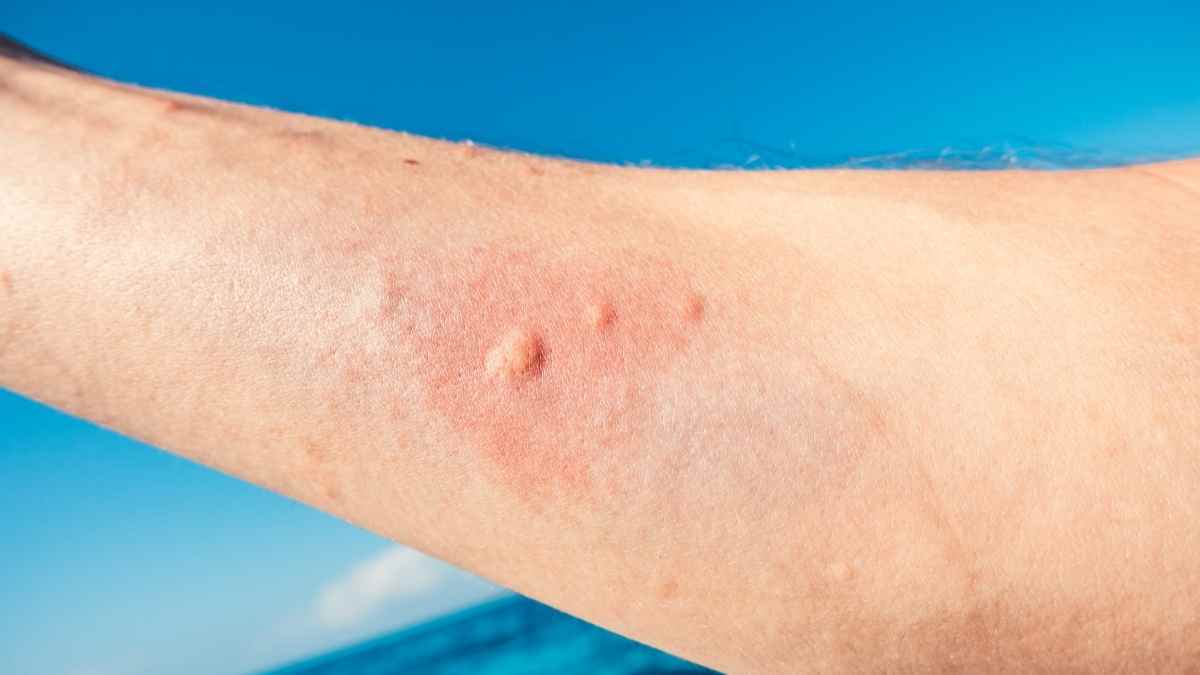 Picadura de una medusa en la playa