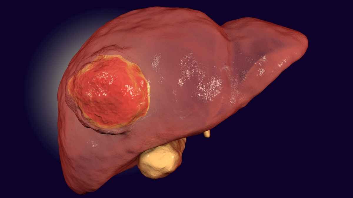 Cáncer de hígado 