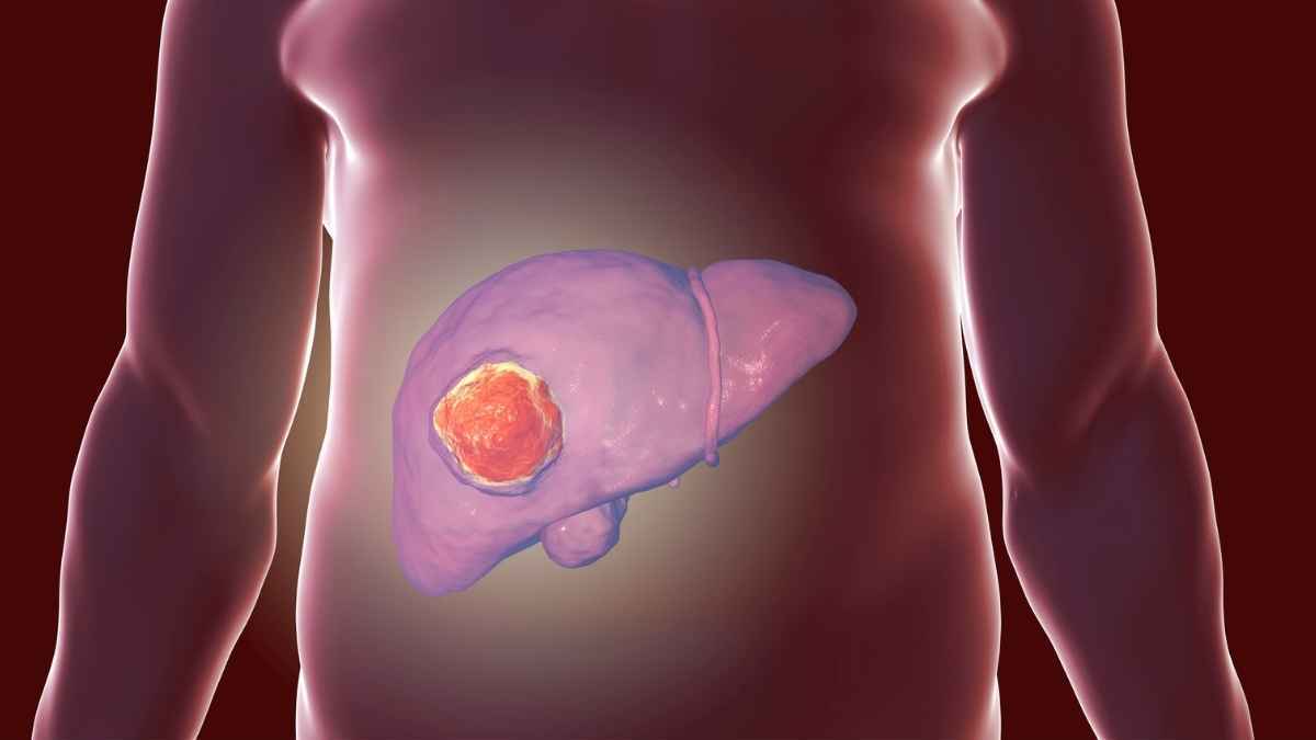Cáncer de hígado  