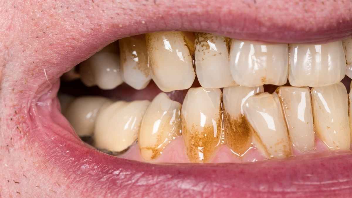 10 son las bacterias que contiene el chicle que te metes en la boca