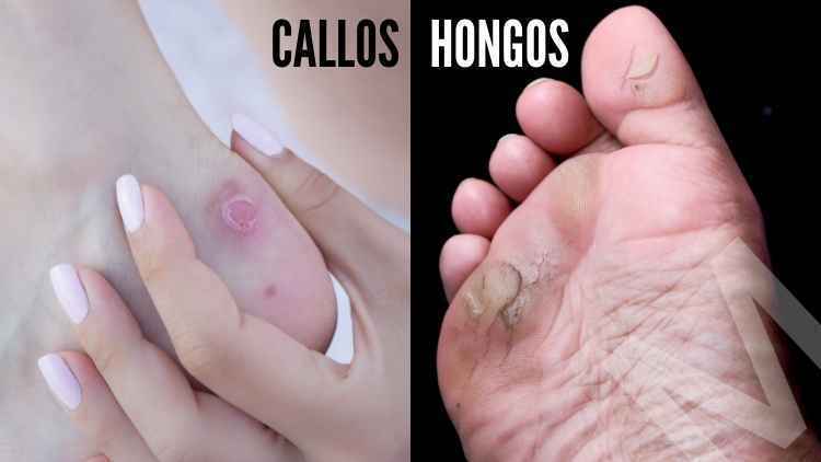 callos hongos