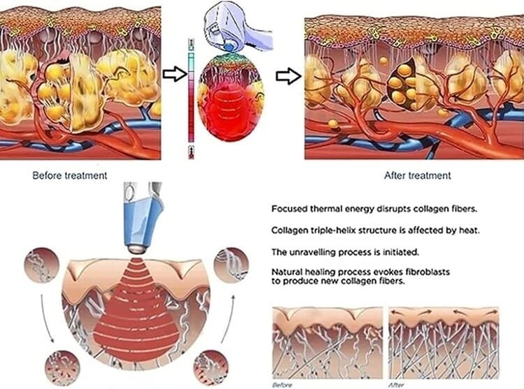 maquina adelgazar (1) (1)