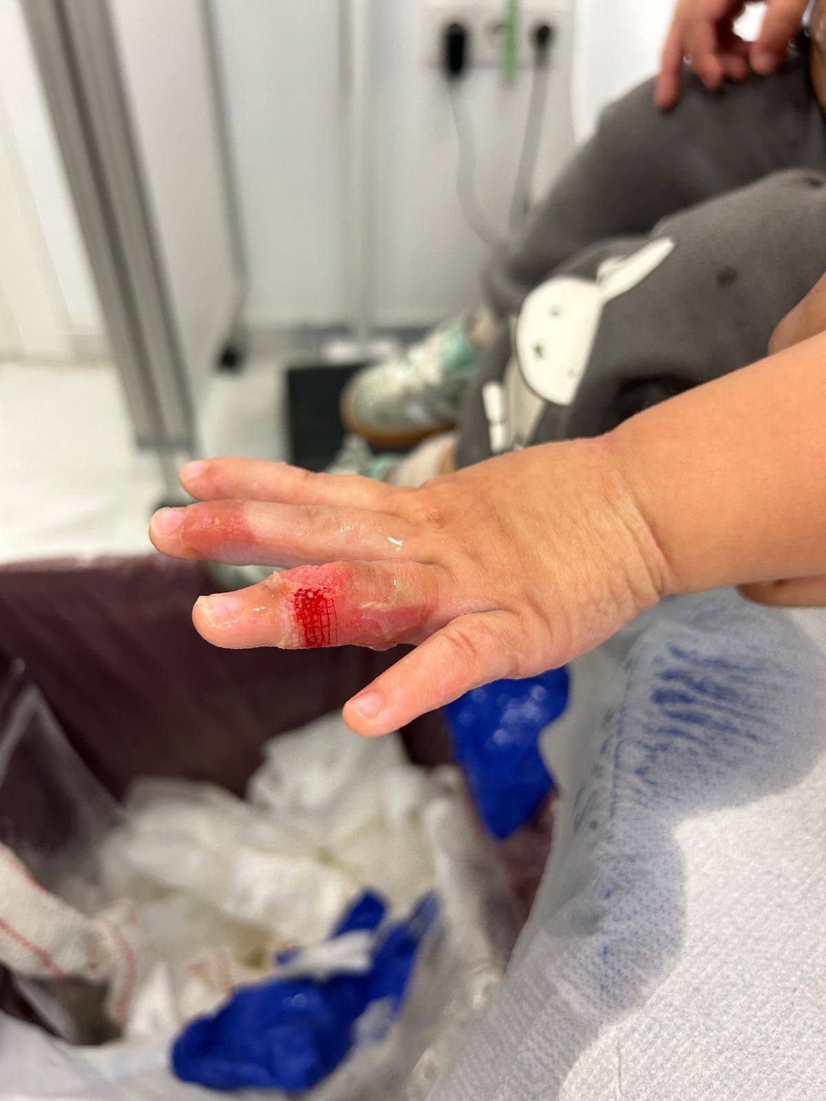 Quemaduras sufridas por un bebé en Jerez tras usar Angry Mama